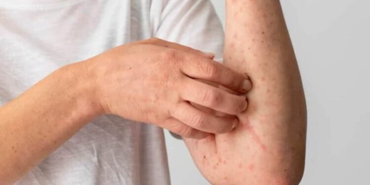 OPS: casos de sarampión en las Américas se multiplicaron por 34 con respecto a 2024