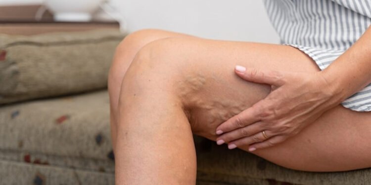 Várices vs. arañas vasculares: diferencias, síntomas y tratamiento 