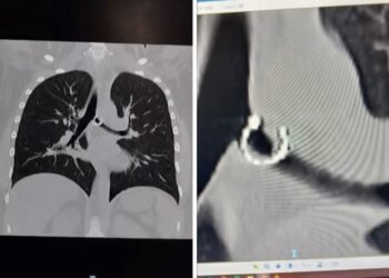 Empezó a toser y un mes después descubrió un objeto insólito en sus pulmones