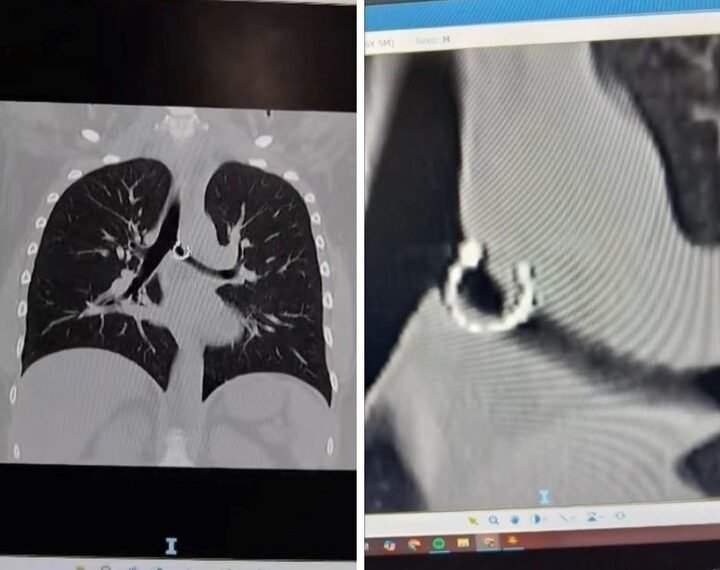 Empezó a toser y un mes después descubrió un objeto insólito en sus pulmones